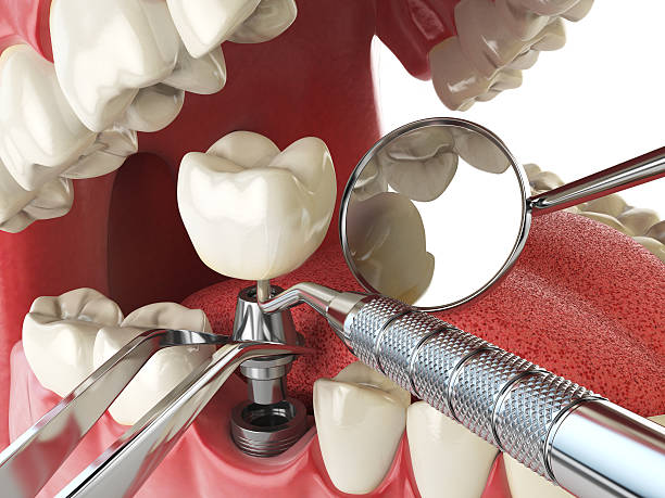Best Emergency Root Canal Therapy in Anderson Creek, NC